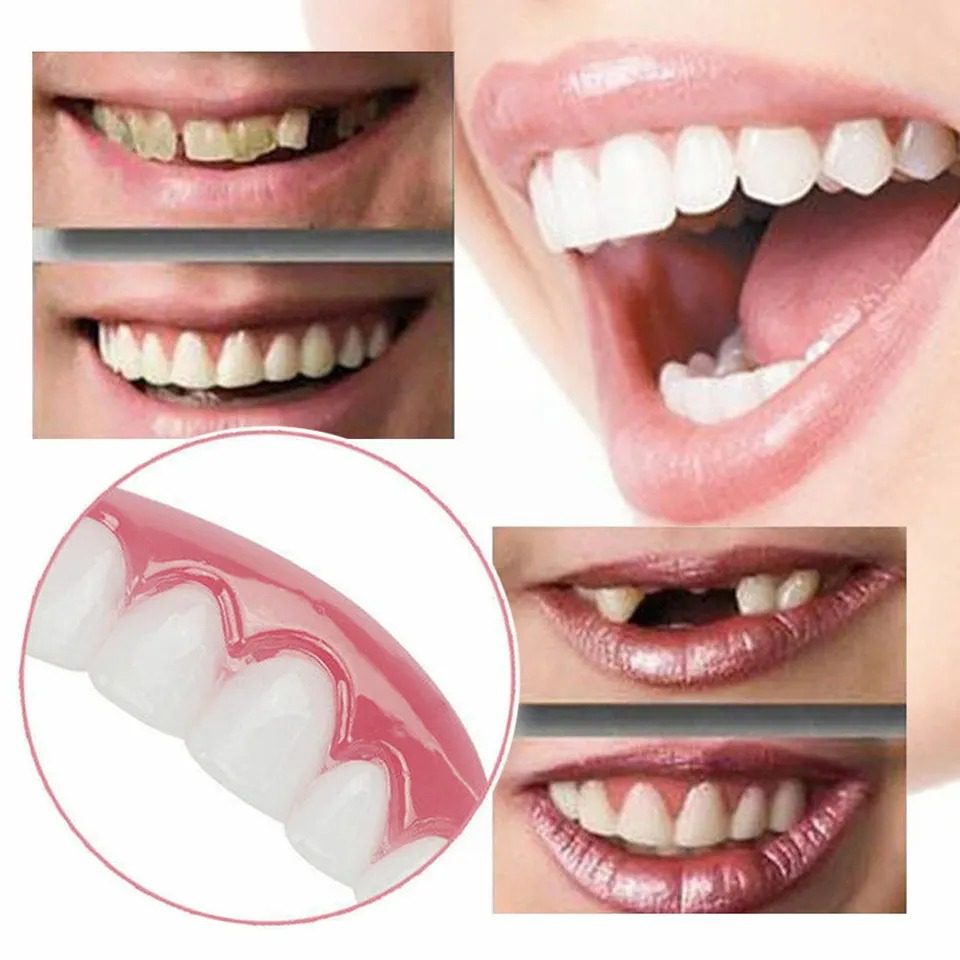 Mnm Box Deals | Perfect Smile Veneers Upper Teeth Perfect Smile Veneers Upper Teeth - Image 5